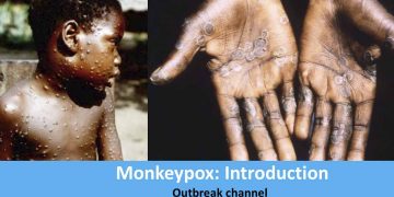 ‘Monkeypox’ spread over 78 countries! over 18,000 infected!