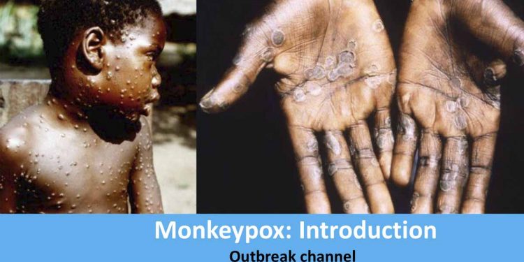 ‘Monkeypox’ spread over 78 countries! over 18,000 infected!