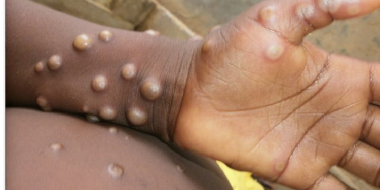 Monkeyfox getting worse!  appears in 75 countries! 16,000 patients  seen! WHO declared a global disaster!