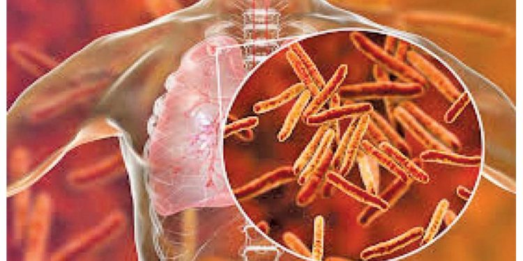Tuberculosis is rapidly spreading.