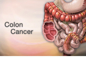 Rapid rise in Colorectal Cancer; adopt healthy lifestyles
