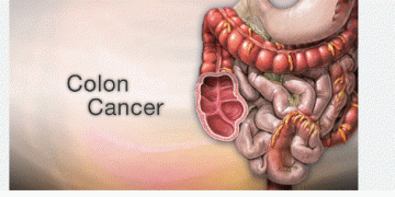 Rapid rise in Colorectal Cancer; adopt healthy lifestyles