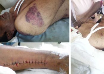 A brutal attack by the Grandpass police on a person! Bruises on every part of the body! An arm fracture! The leg has a two-foot seam! Applying pressure to withdraw the complaint!