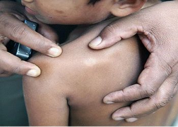 Leprosy cases are increasing in the Gampaha district, with 42 new cases reported in the last three months.