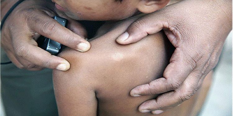 Leprosy cases are increasing in the Gampaha district, with 42 new cases reported in the last three months.