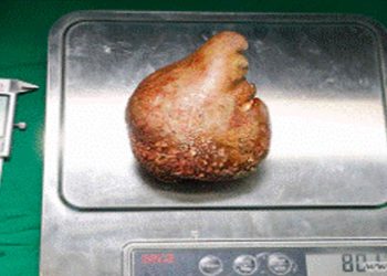 Doctors remove “world’s largest kidney stone” from retired soldier in Sri Lanka  I Sri Lanka Latest News