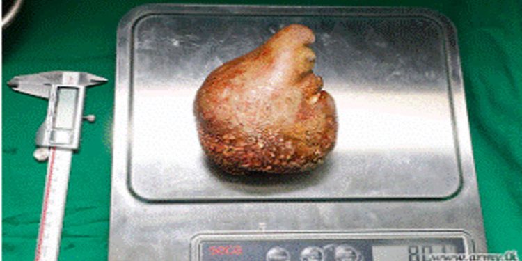 Doctors remove “world’s largest kidney stone” from retired soldier in Sri Lanka  I Sri Lanka Latest News