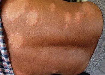 The spread of leprosy is accelerating in Kalutara District. Health alert! I Sri Lanka Latest News