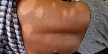 The spread of leprosy is accelerating in Kalutara District. Health alert! I Sri Lanka Latest News