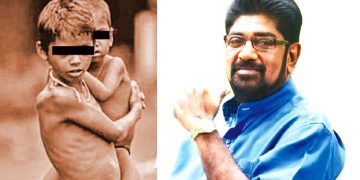 400 malnourished children grew up in just one province of Keheliya’s election district! 25 children suffer from acute malnutrition! Sri Lanka Latest News