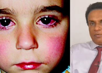 Common eye disease spread among children? Be cautious ! Sri Lanka Latest News