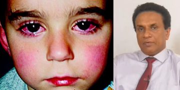 Common eye disease spread among children? Be cautious ! Sri Lanka Latest News