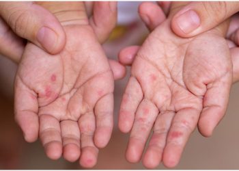 Outbreak of Coxsackie Virus Among Children Sparks Concern in Sri Lanka: Health Authorities on Alert