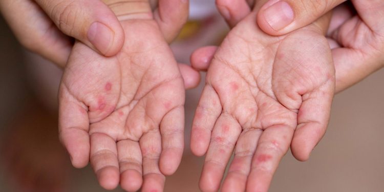 Outbreak of Coxsackie Virus Among Children Sparks Concern in Sri Lanka: Health Authorities on Alert