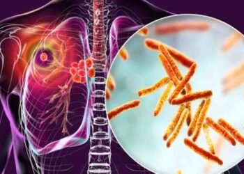Tuberculosis in Sri Lanka: Western Province Records Nearly Half of Annual Cases